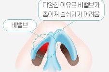 韩国温度整形鼻畸形矫正术功能与美观兼顾,鼻塞/鼻炎均改善