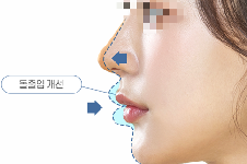 韩国温度整形单纯隆鼻和同时进行人中/短下巴矫正区别在此
