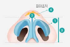 鼻头圆钝怎么改变?韩国温度整形钝平鼻尖矫正术改善钝鼻头