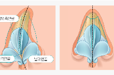 鼻中隔偏曲可以做隆鼻手术吗?各种鼻畸形修复认准韩国温度
