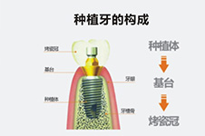 南寧口碑好的口腔醫(yī)院盤點，種植矯正價格曝光！