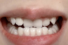 西安海涛口腔种植牙有什么优势？还有牙齿矫正案例！