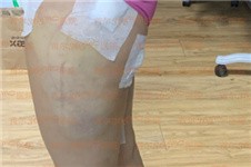 韩国365mc吸脂医院大腿抽脂后淤青肿胀什么时候能消退？