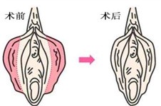 南寧哪個(gè)整形醫(yī)院有私密?內(nèi)陰道緊致+外陰漂紅價(jià)格優(yōu)惠！