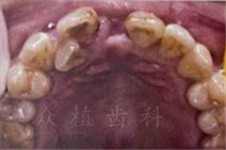 太原众植齿科医院怎么样 7000元的进口种植牙靠谱吗