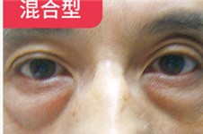 太原不開刀去眼袋可靠嗎 才弄懂原來是這個技術(shù)