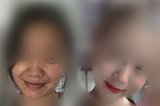 脸部线雕恢复过程图片真实记录从大妈变少女的过程