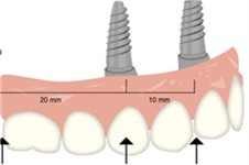 全口牙缺失种植方案有哪些 All-on-4和All-on-x有什么区别