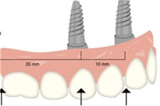 全口牙缺失種植方案有哪些 All-on-4和All-on-x有什么區(qū)別
