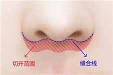 合肥哪里做人中縮短手術(shù) 這幾家有排名的醫(yī)院記得先去面診