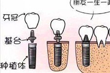 年轻人用韩国登腾种植牙可以吗 不同年龄种植体应该怎么选