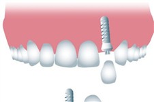 科普：種植體埋入式和非埋入式區(qū)別 哪種植入方式更好
