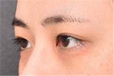 韩国做眼睛出名的医生都有谁 初眼和修复的技术都不错