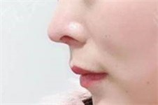 韩国隆鼻手术医生10大排行榜公布 术后照片惊艳到想不到