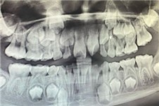 合肥种植牙多少钱 这里有一份技术好的正规口腔医院价格表