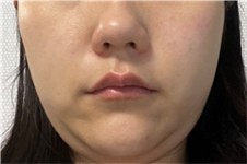 韩国365mc双下巴抽脂案例分享 瓜子脸也不需要做磨骨手术