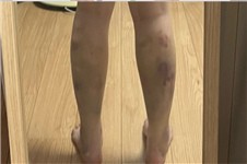 韩国小腿吸脂哪家好 看365mc医院的瘦小腿案例合集