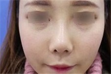 韩国做肋骨鼻哪个医生技术好 这几位做假体和肋骨都不错
