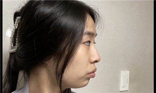 韩国可来熙外科眼睛鼻子整形亲身经历分享 