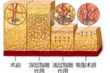 威塑抽脂和水動力吸脂區(qū)別是什么?哪個吸脂方式更好?