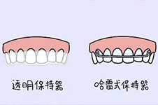 突嘴牙齒矯正多少錢?矯正需要拔牙嗎?看文章細(xì)說!