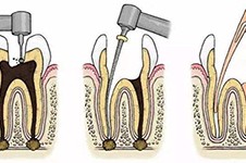 根管治疗不成功的表现,治疗完还是牙疼是失败了吗?