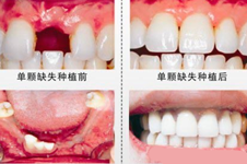 2021宁波口腔医院种植牙收费价目表，种牙好的医师有哪些?