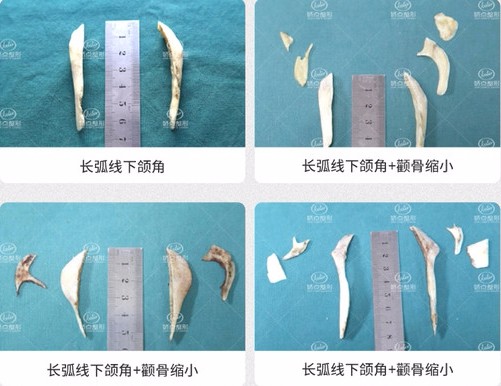 昆明轮廓手术做的好的医生推荐谁?颌面整形要花多少钱?