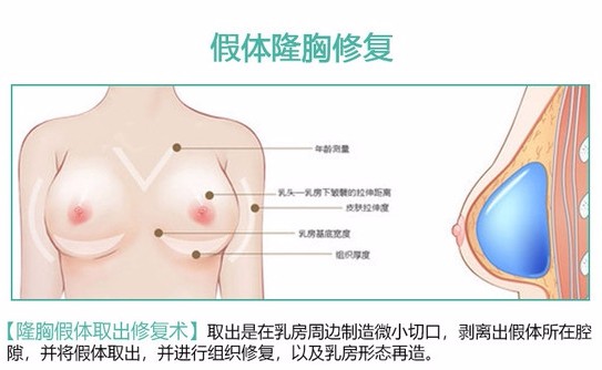 昆明胸部修复哪家好?公布本地隆胸修复医生以及修复价格!