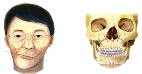 沈陽正頜手術(shù)誰做的好?求推薦正頜手術(shù)做的好的醫(yī)生名單!