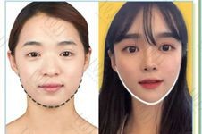 韩国面部轮廓手术哪家技术好?推荐韩国WJ原辰整形改脸型好!