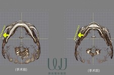 韩国面部轮廓手术哪家技术好?看WJ原辰朴钟哲磨骨案例惊艳!