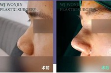 听说韩国原辰的名品鼻很出名,来看看WJ原辰的鼻部整形方法!