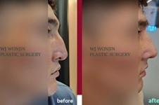 韩国隆鼻手术哪家好?改善鼻部形态还得找WJ原辰整形隆鼻!