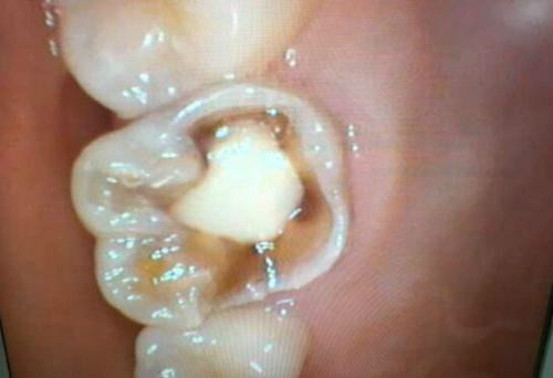 种植牙的牙龈出现瘘管是正常情况吗?很多人不知道怎么治疗 