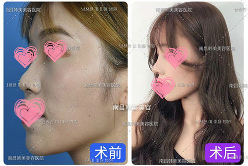 南昌隆鼻哪个医生好 南昌做鼻子有名的医生及手术价格介绍 非常爱美