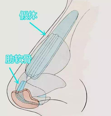 肋软骨鼻综合价格一般是多少!南京鼻整形比较好的医生有谁?