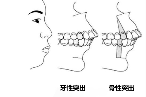 有人說門牙外凸不建議再矯正了?那門牙突出要怎么矯正好?