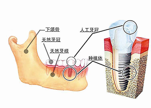 種植牙怎么那么貴啊?是否是暴利?種植牙材料成本是多少?