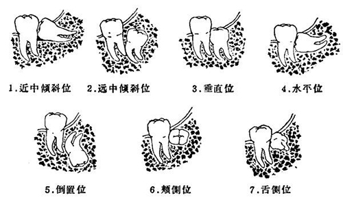 武汉拔智齿多少钱一颗?武汉拔智齿可以医保报销吗?