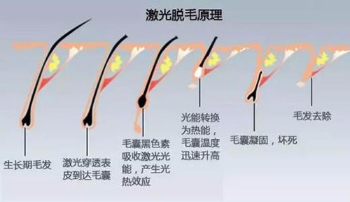 貴陽激光脫毛哪里好?貴陽脫毛好且正規(guī)的醫(yī)院名單匯總!