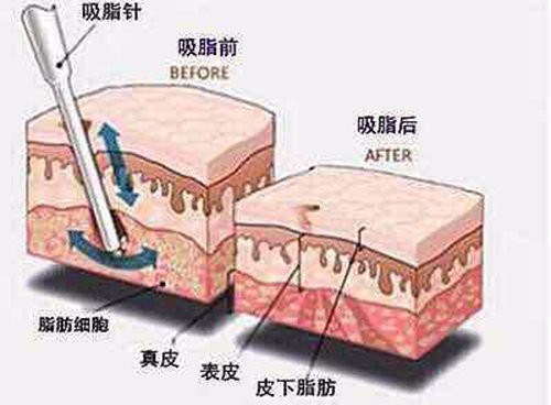 福州抽脂贵吗?更新福州吸脂好医院全身各部位抽脂价格!