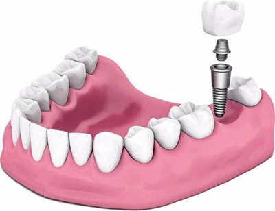 莆田种植牙价格表公开，做种植牙多少钱一颗明细清单!