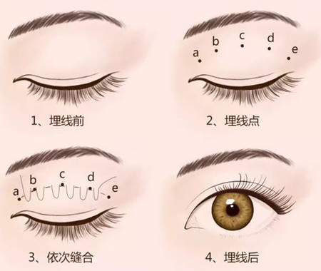 埋线双眼皮分几种类型?详解什么样的眼皮适合做埋线!