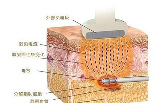 福州黄金微雕哪里做的好?有无好的医院或医生推荐?!