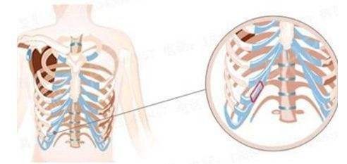 什么人不适合做肋骨鼻?肋软骨再好不适合也白搭!