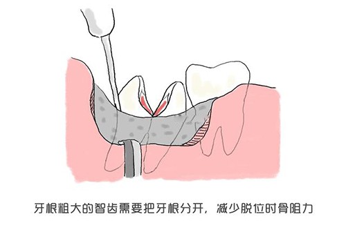 厦门拔智齿多少钱一颗?哪里可以使用医疗保险报销呀?