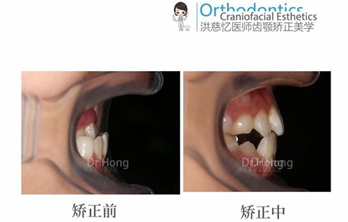 厦门牙科医院牙齿矫正收费标准公开,麦芽峰煜正畸费用都有!