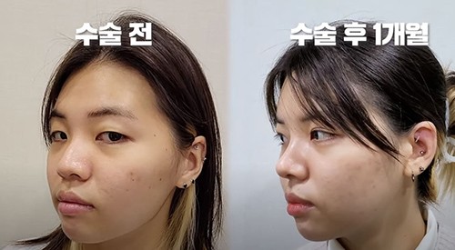 分享韩国迪美整形医院眼鼻脂肪填充案例,变美三件套很哇塞!