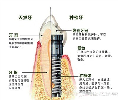 三明种植牙多少钱一颗?口碑牙科种牙仅5000起,含厉害的医生!